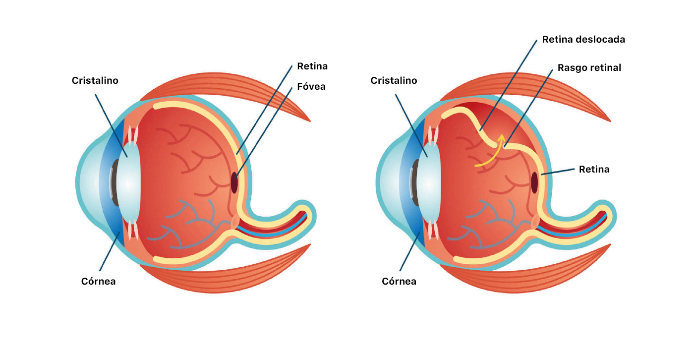 O descolamento de retina é considerado caso de urgência! - NeoOftalmo