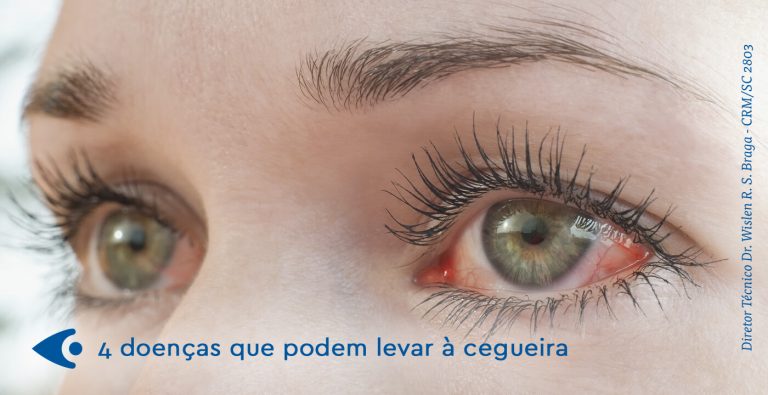 4 Doenças Que Podem Levar à Cegueira Hospital De Olhos De Santa Catarina 9210